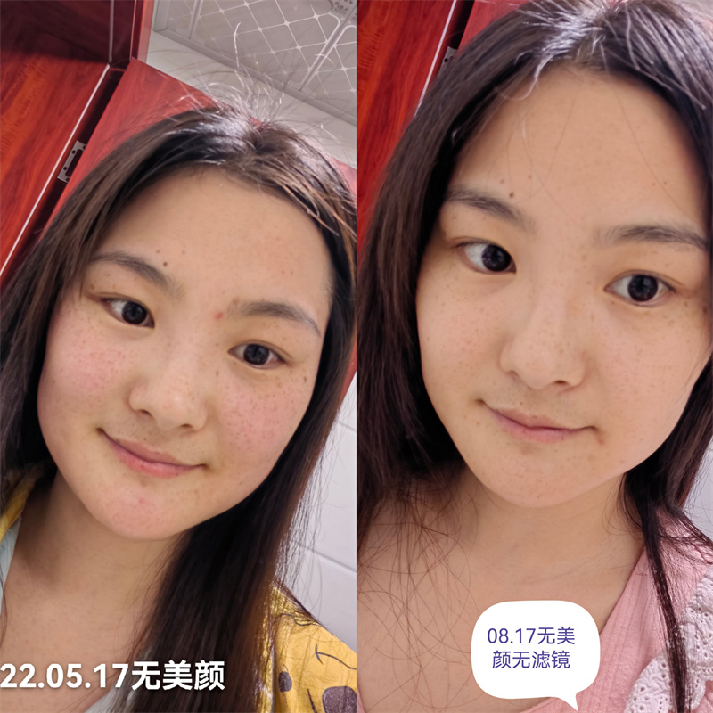 淡斑提亮案例