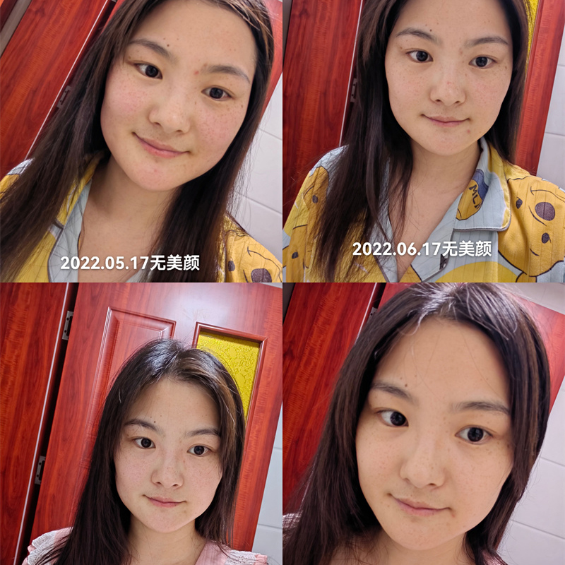 淡斑提亮案例
