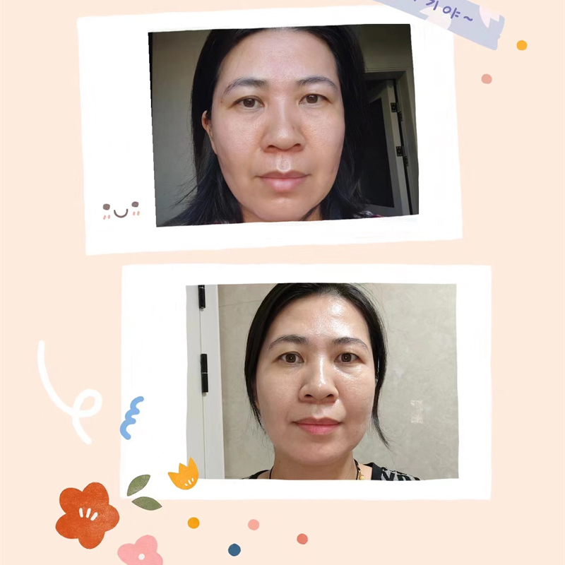 抗衰去皱案例