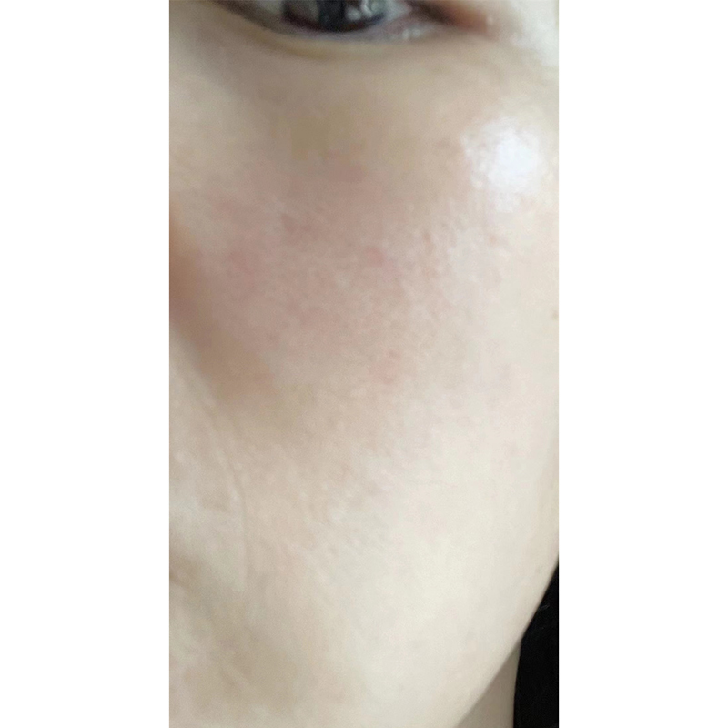 抗衰去皱案例