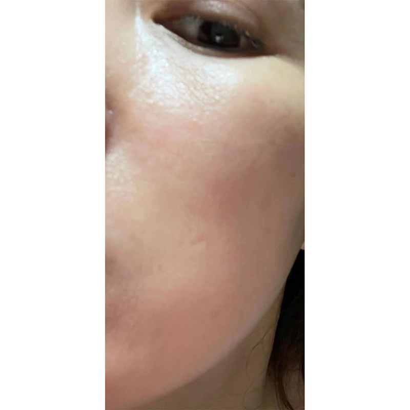 抗衰去皱案例