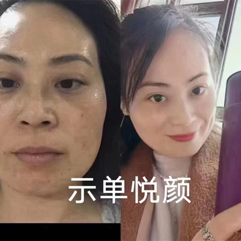 抗衰去皱案例