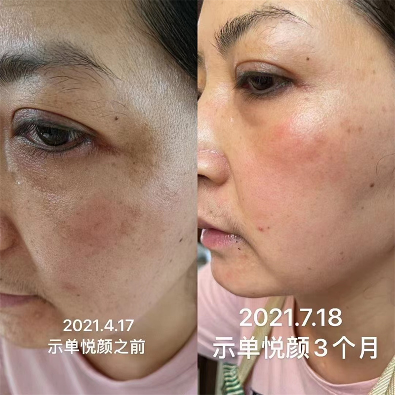 抗衰去皱案例