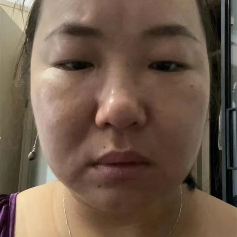 排异案例
