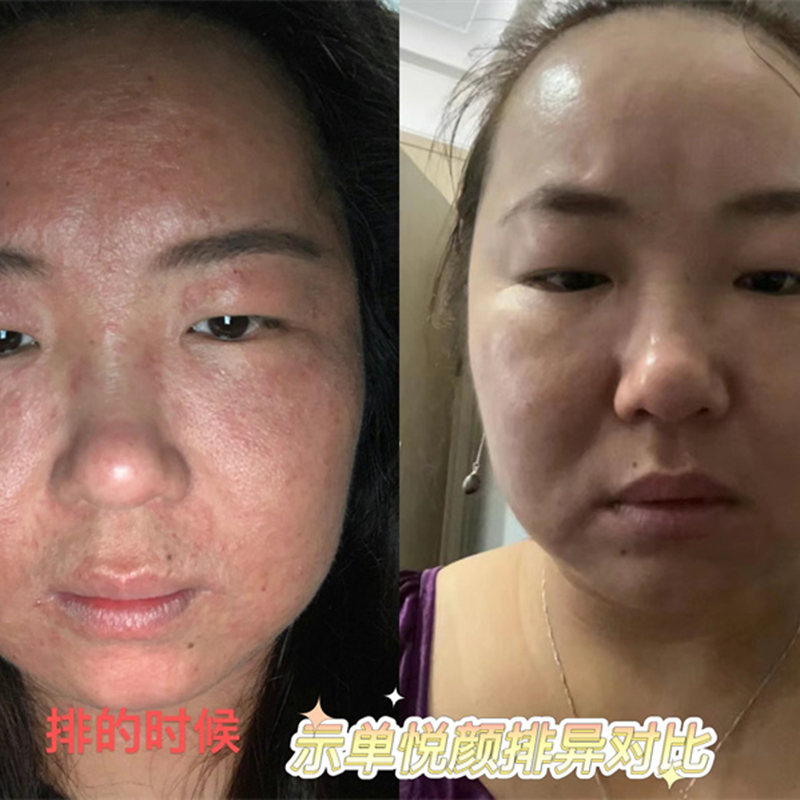排异案例