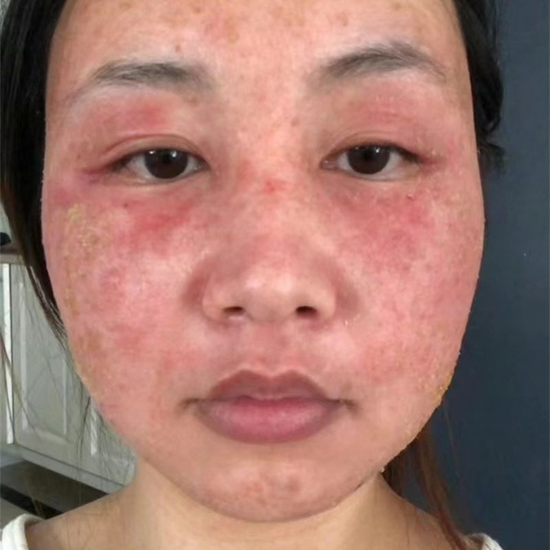 排异案例