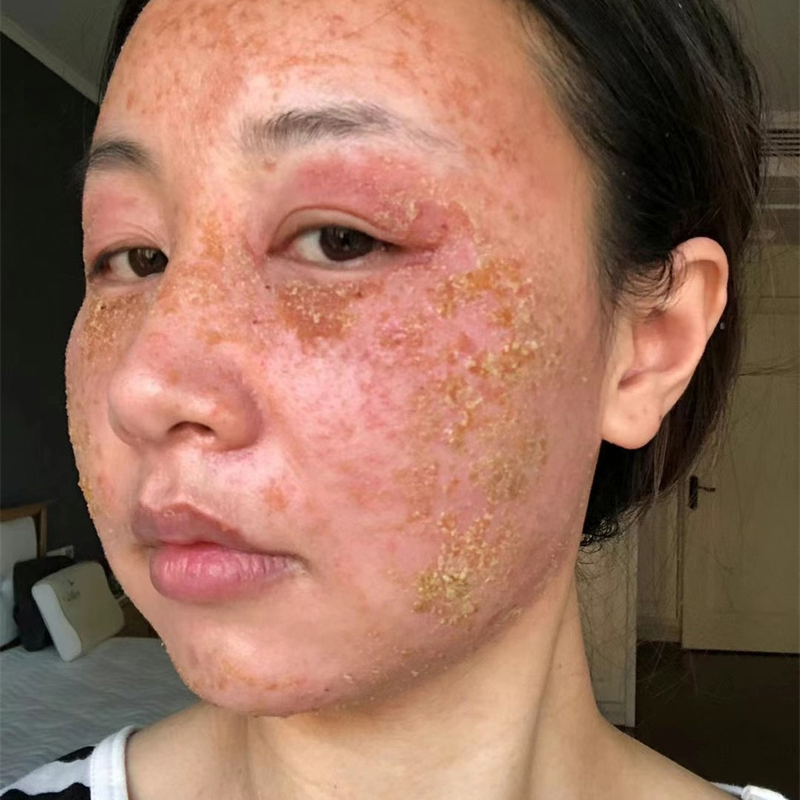 排异案例