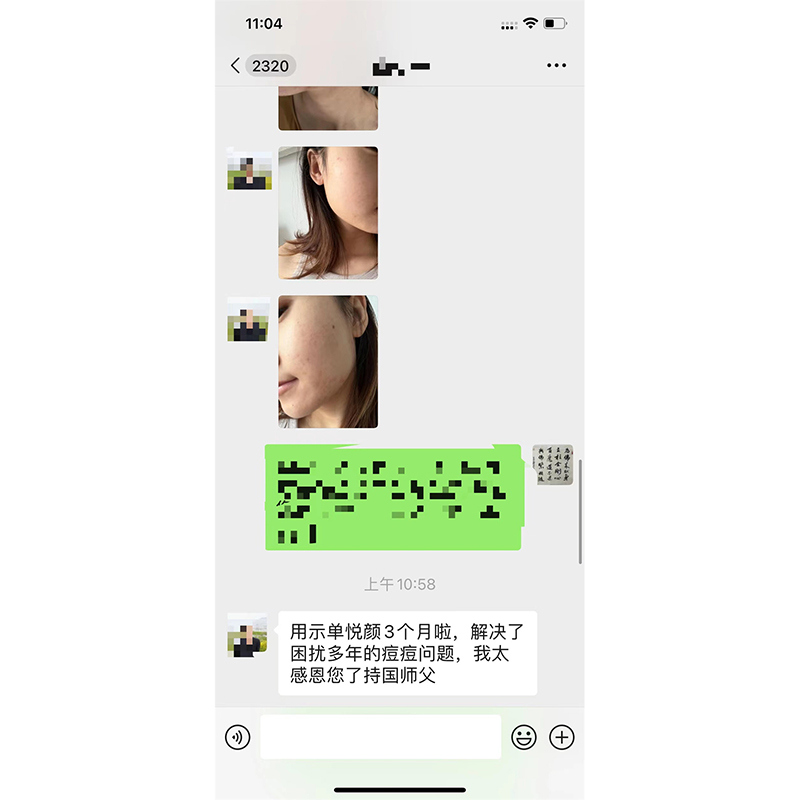 去痘痘印案例