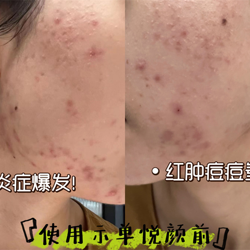 去痘痘印案例