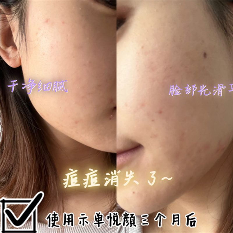 去痘痘印案例