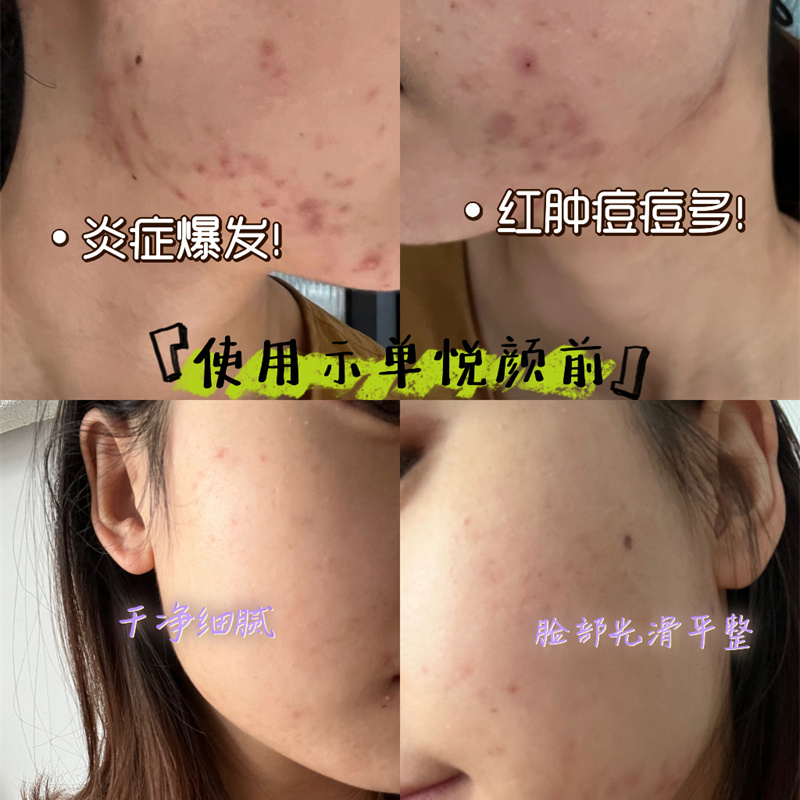 去痘痘印案例